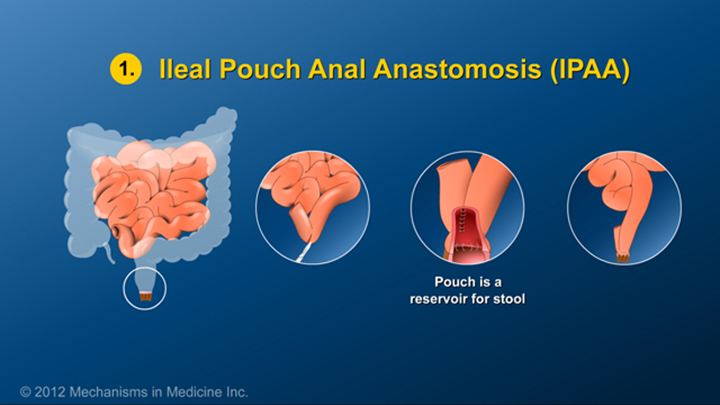 Small Bowel and Large Bowel Surgery for IBD