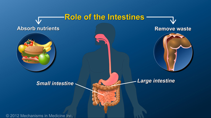 What Is An Ileostomy