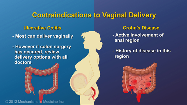 Optimizing Pregnancy with IBD