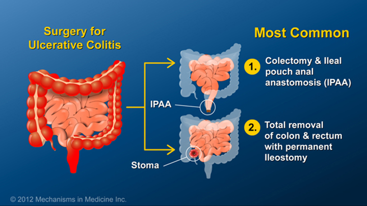 Slide Show Small Bowel And Large Bowel Surgery For Ibd