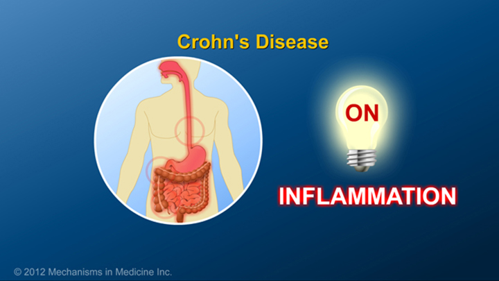 Inflammation with Crohn’s