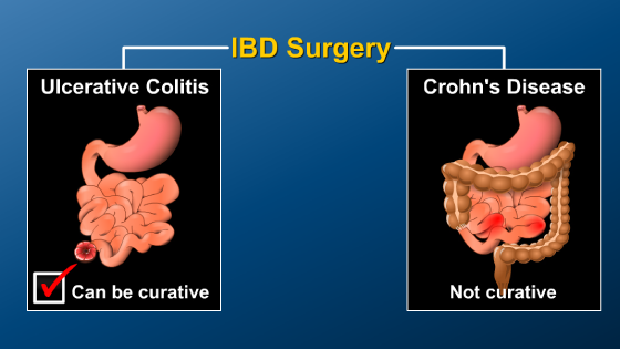 Small Bowel And Large Bowel Surgery For Ibd 0082
