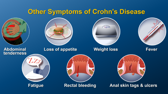 Diagnosing IBD