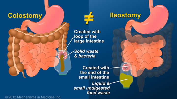 Slide Show What Is An Ileostomy