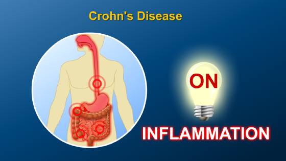 Diagnosing IBD ulcerative colitis diagram 